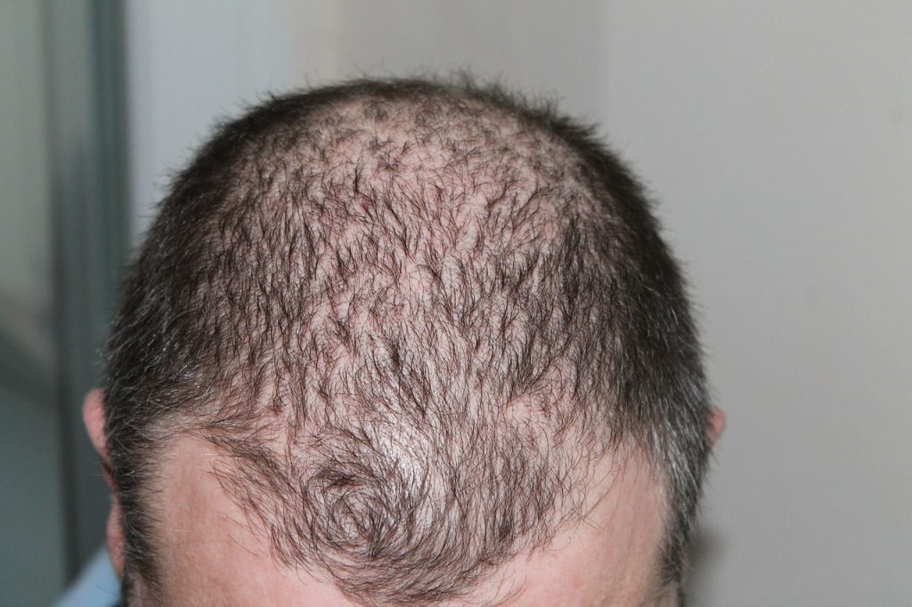 Castor oil against hair loss